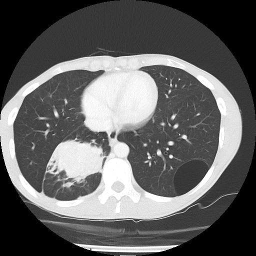 Bronchial carcinoid tumor causing right lower lobe collapse (Radiopaedia 83495-98594 Axial lung window 38).jpg
