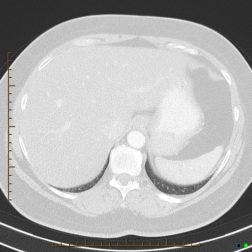 Bronchial diverticula (Radiopaedia 79512-92675 Axial lung window 44).jpg