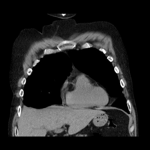 Bronchial stenosis - lung transplant (Radiopaedia 73133-83848 Coronal non-contrast 22).jpg