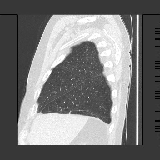 Bronchial stenosis - lung transplant (Radiopaedia 73133-83848 Sagittal lung window 15).jpg