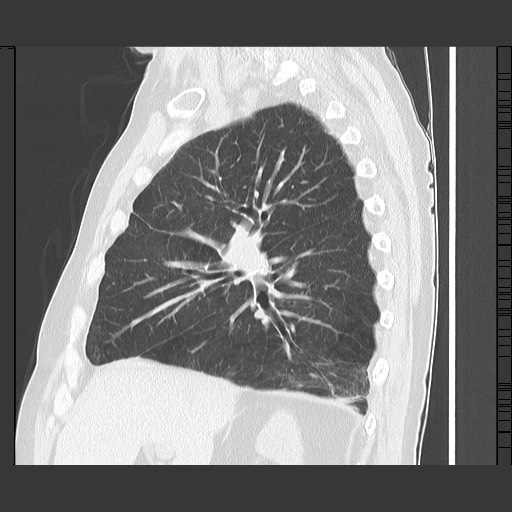 Bronchial stenosis - lung transplant (Radiopaedia 73133-83848 Sagittal lung window 26).jpg