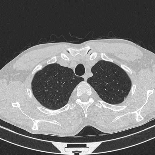 Bronchocele (Radiopaedia 60676-68429 Axial lung window 10).jpg