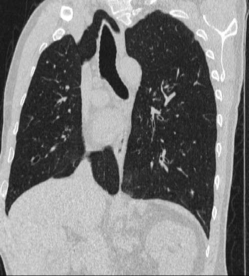File:Bronchocele (Radiopaedia 60676-68429 Oblique lung window 18).jpg