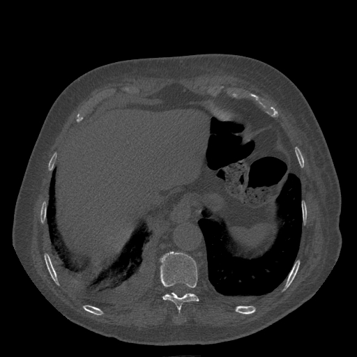 Bronchogenic carcinoma with metastatic lymphadenopathy (Radiopaedia 37671-39569 Axial bone window 46).jpg
