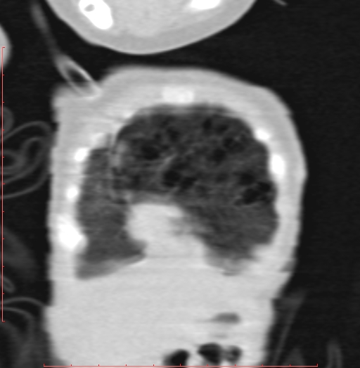 File:Bronchogenic cyst (Radiopaedia 78599-91409 Coronal lung window 30).jpg