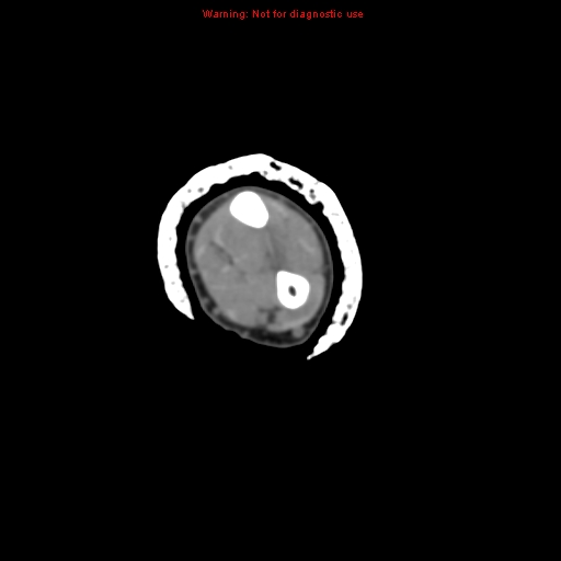 Brown tumor (Radiopaedia 12460-12694 Axial non-contrast 75).jpg
