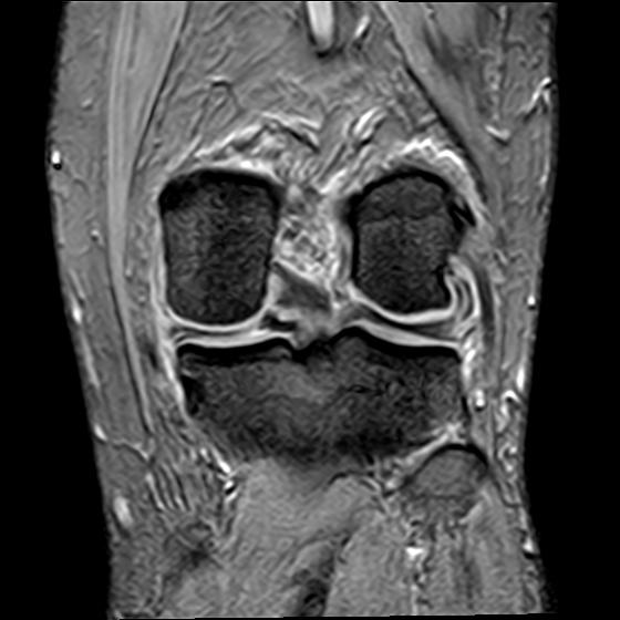 File:Bucket handle tear - medial meniscus (Radiopaedia 29250-29664 B 14).jpg