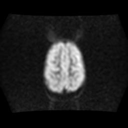 File:Burkitt lymphoma of the orbit- pre and post chemotherapy (Radiopaedia 31214-31930 Axial DWI 15).jpg