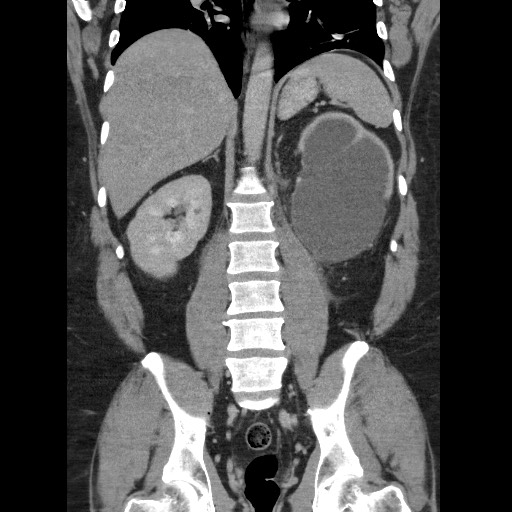 Burned-out testicular seminoma - retroperitoneal nodal metastases (Radiopaedia 62872-71245 B 44).jpg