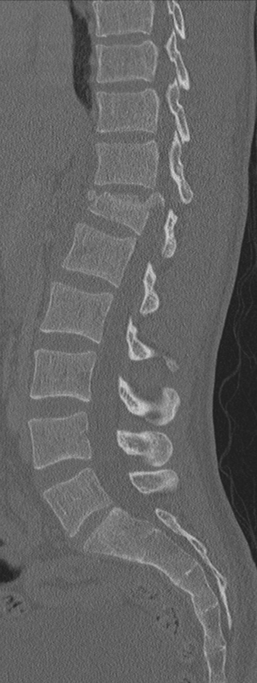 Burst fracture - T12 with conus compression (Radiopaedia 56825-63647 Sagittal bone window 46).png