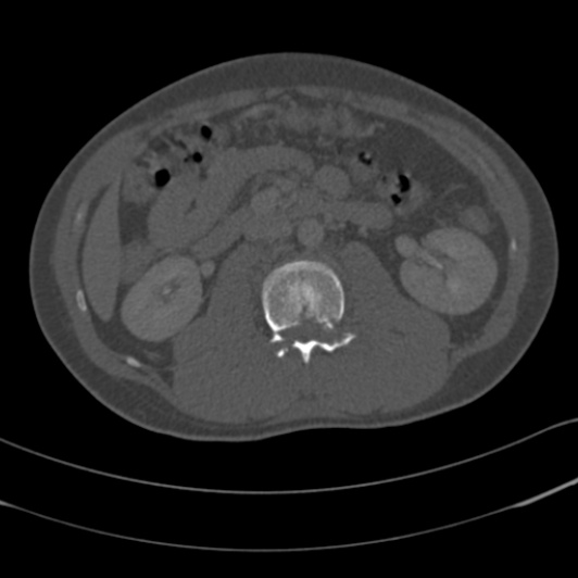 Burst fracture with cauda equina syndrome (Radiopaedia 25701-25867 Axial bone window 50).jpg