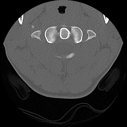 File:C5 facet fracture (Radiopaedia 58374-65499 Axial bone window 18).jpg