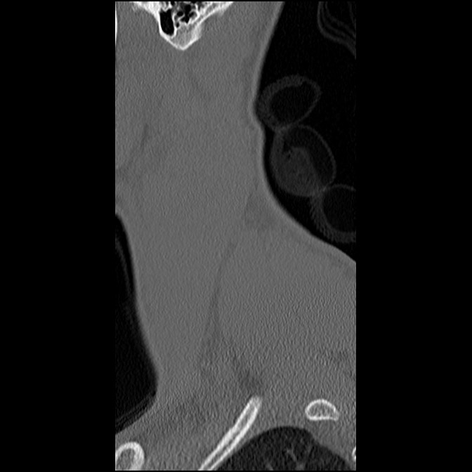 C5 facet fracture (Radiopaedia 58374-65499 Sagittal bone window 65).jpg