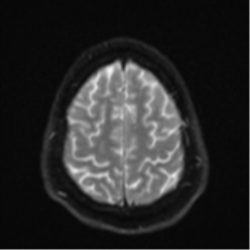 File:CNS vasculitis (Radiopaedia 55715-62263 Axial DWI 25).png