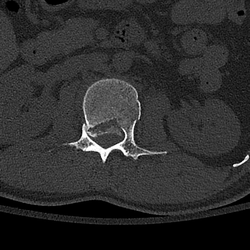 Calcaneal fractures with associated L2 burst fracture (Radiopaedia 71671-82493 Axial bone window 38).jpg