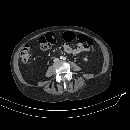 Calcified adrenal glands and Spigelian hernia (Radiopaedia 49741-54988 A 124).jpg
