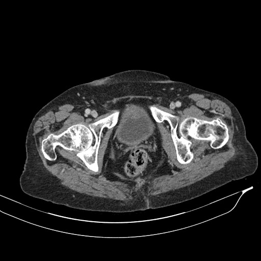 Calcified adrenal glands and Spigelian hernia (Radiopaedia 49741-54988 A 239).jpg