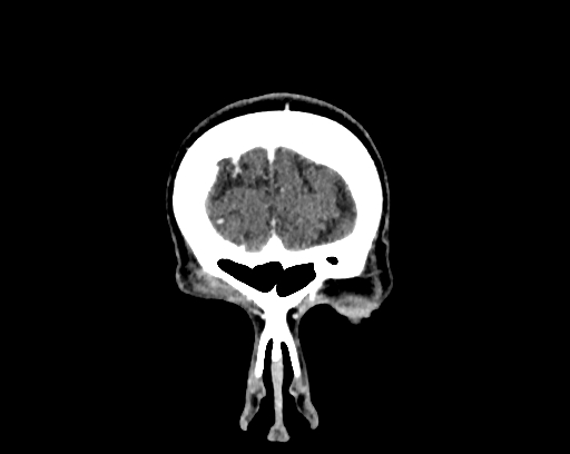 Calcified cerebral hydatid cyst (Radiopaedia 65603-74717 C 1).jpg
