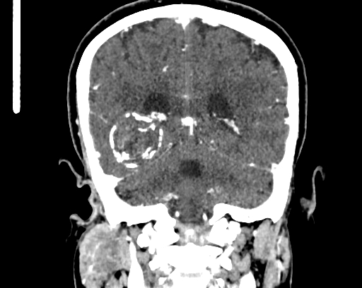 Calcified cerebral hydatid cyst (Radiopaedia 65603-74717 C 49).jpg