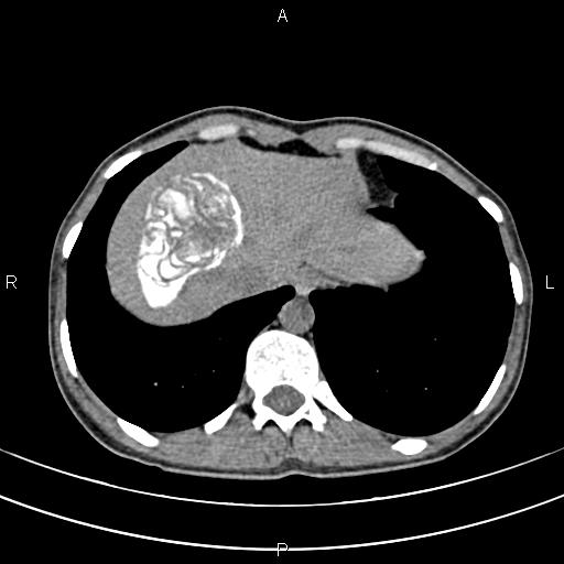 File:Calcified hepatic hydatid cyst (Radiopaedia 83870-99072 Axial non-contrast 20).jpg