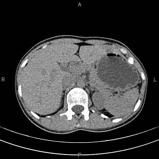 File:Calcified hepatic hydatid cyst (Radiopaedia 83870-99072 Axial non-contrast 48).jpg