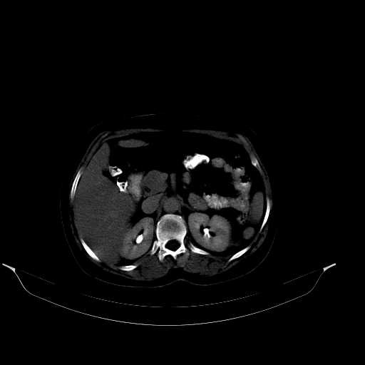 File:Calcified hydatid cyst of the liver (Radiopaedia 21212-21112 Axial bone window 19).jpg