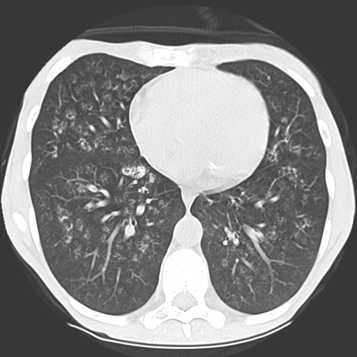 File:Calciphylaxis and metastatic pulmonary calcification (Radiopaedia 10887-11317 Axial lung window 30).jpg