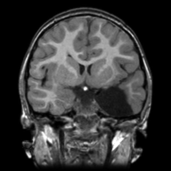 File:Callosal dysgenesis and ectopic posterior pituitary (Radiopaedia 8382-9213 Coronal T1 1).jpg