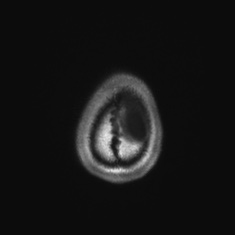 Callosal dysgenesis with interhemispheric cyst (Radiopaedia 53355-59335 Axial T1 154).jpg