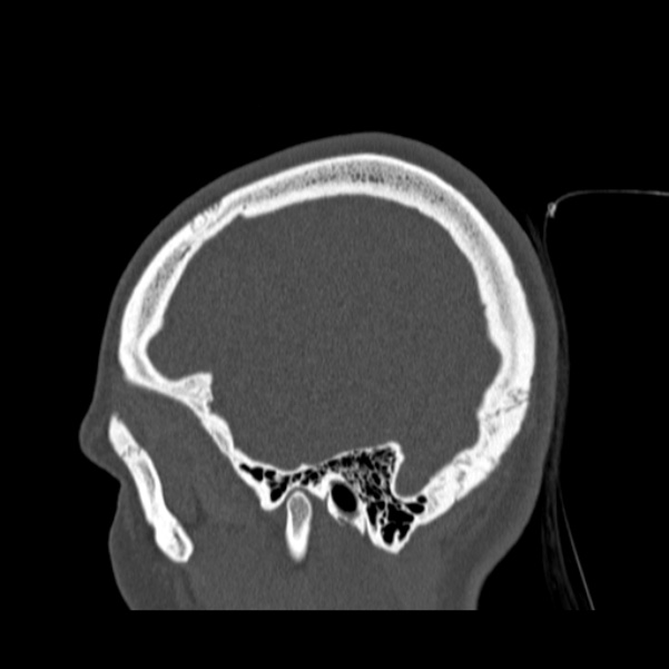 Calvarial osteoma (Radiopaedia 36520-38079 Sagittal bone window 90).jpg