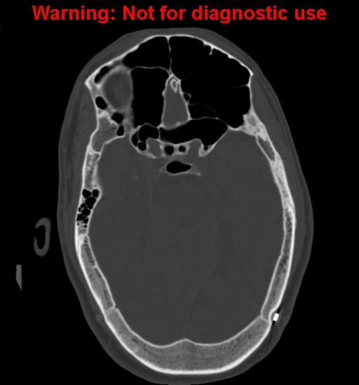 Calvarial thickening from chronic shunting (Radiopaedia 60079-67637 Axial bone window 70).jpg