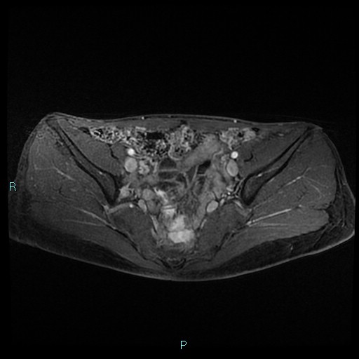 File:Canal of Nuck cyst (Radiopaedia 55074-61448 Axial T1 C+ fat sat 22).jpg