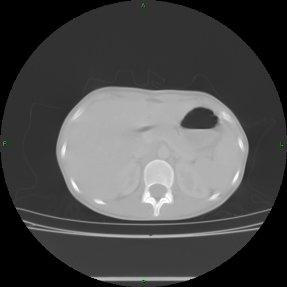 File:Cannon ball metastases - synovial sarcoma (Radiopaedia 26135-26271 Axial lung window 38).jpg