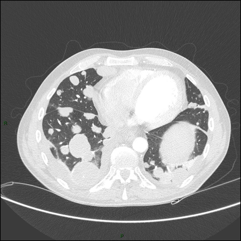 Cannonball metastases (Radiopaedia 82110-96150 Axial lung window 137).jpg