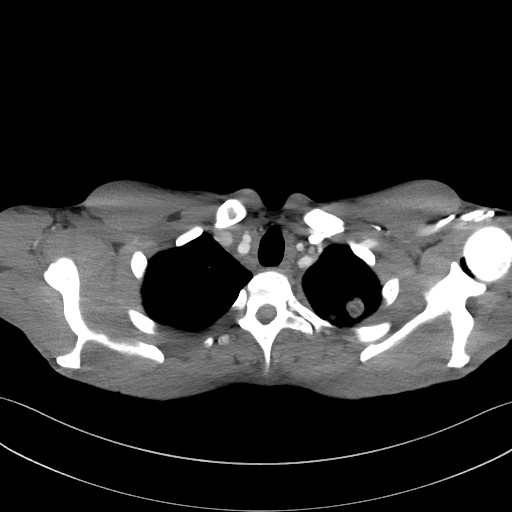 Cannonball metastases - testicular choriocarcinoma (Radiopaedia 84510-99891 B 24).jpg