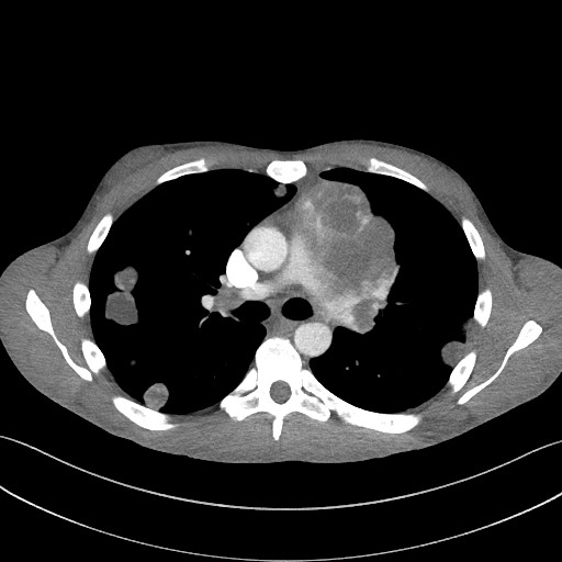 Cannonball metastases - testicular choriocarcinoma (Radiopaedia 84510-99891 B 52).jpg