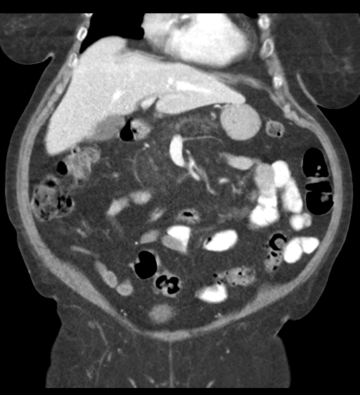 Cannonball metastases from endometrial cancer (Radiopaedia 42003-45031 F 27).png