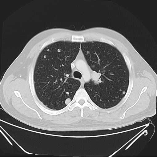File:Cannonball pulmonary metastases (Radiopaedia 67684-77101 Axial lung window 8).jpg