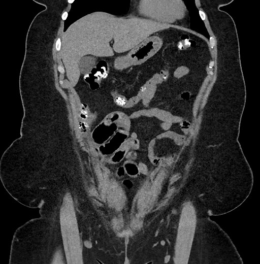 Carcinoid tumor - terminal ileum (Radiopaedia 60931-68740 Coronal non-contrast 23).jpg