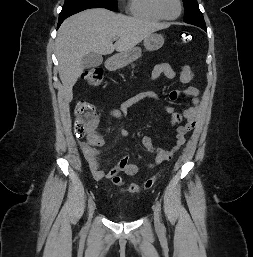 Carcinoid tumor - terminal ileum (Radiopaedia 60931-68740 Coronal non-contrast 32).jpg