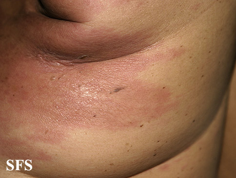Carcinoma Erysipeloides (Dermatology Atlas 10).jpg