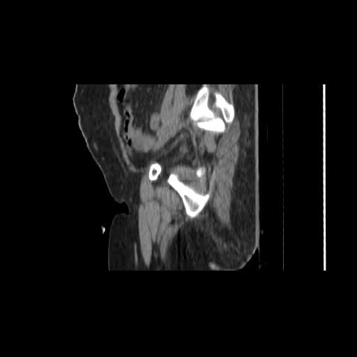 File:Carcinoma cervix- brachytherapy applicator (Radiopaedia 33135-34173 D 38).jpg
