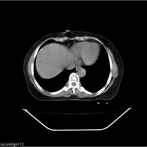 File:Carcinoma cervix- recurrence (Radiopaedia 34702-36137 Axial non-contrast 6).jpg