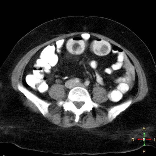 File:Carcinoma of sigmoid colon (Radiopaedia 23071-23100 C+ arterial phase 16).jpg