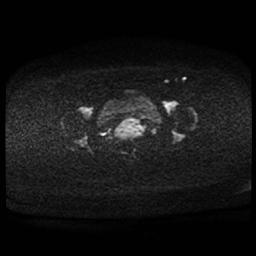 Carcinoma of the cervix (Radiopaedia 89018-105858 Axial DWI 71).jpg