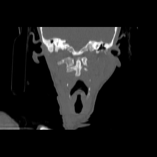 Carcinoma of the maxillary antrum (Radiopaedia 53805-59888 Coronal bone window 90).jpg