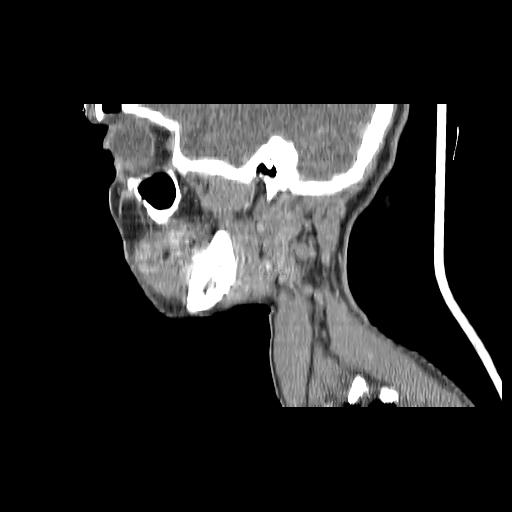 Carcinoma of the maxillary antrum (Radiopaedia 53805-59888 Sagittal C+ delayed 137).jpg