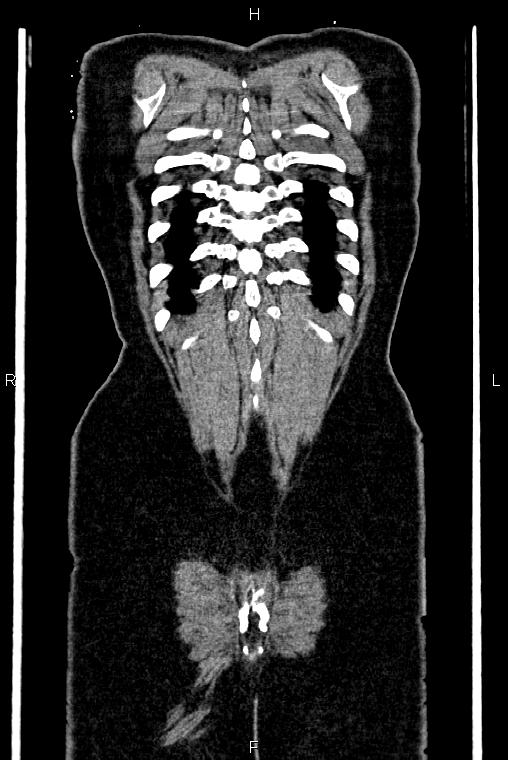 Carcinoma of uterine cervix (Radiopaedia 85861-101700 C 56).jpg