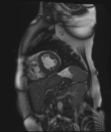 Cardiac amyloidosis (Radiopaedia 51404-57150 Sagittal CINE SSFP 145).jpg