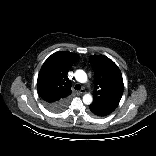 File:Cardiac lymphoma (Radiopaedia 38690-40836 Axial C+ CTPA 4).jpg